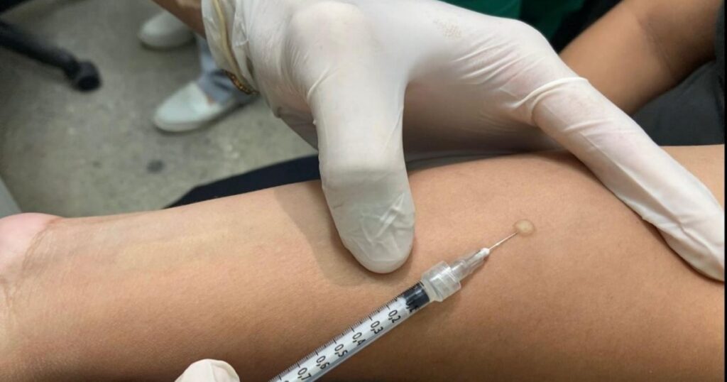 PPD não confirma tuberculose ativa e passa a ser oferecido em 55 unidades de Manaus