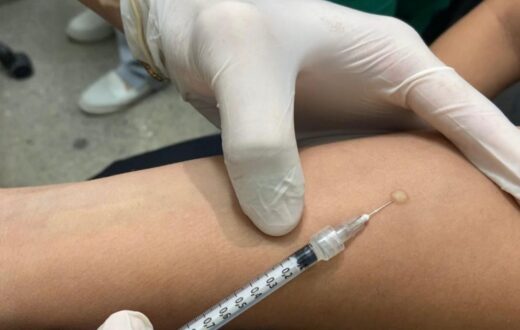 PPD não confirma tuberculose ativa e passa a ser oferecido em 55 unidades de Manaus